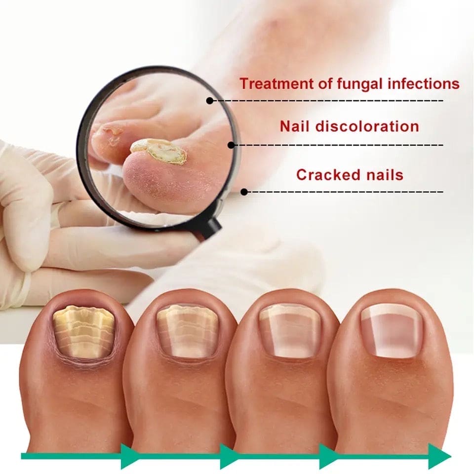 Nail Fungus Solution, Anti Infection Nail Fungus Removal Gel, Ingrown Toenail Treatment Nail Care Oil, Nail Fungus Treatments Serum