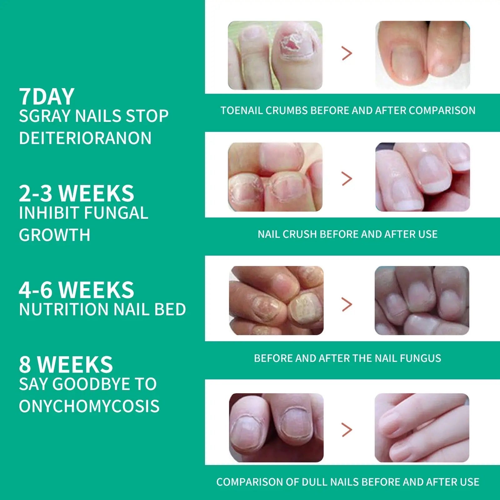 Nail Fungus Solution, Anti Infection Nail Fungus Removal Gel, Ingrown Toenail Treatment Nail Care Oil, Nail Fungus Treatments Serum