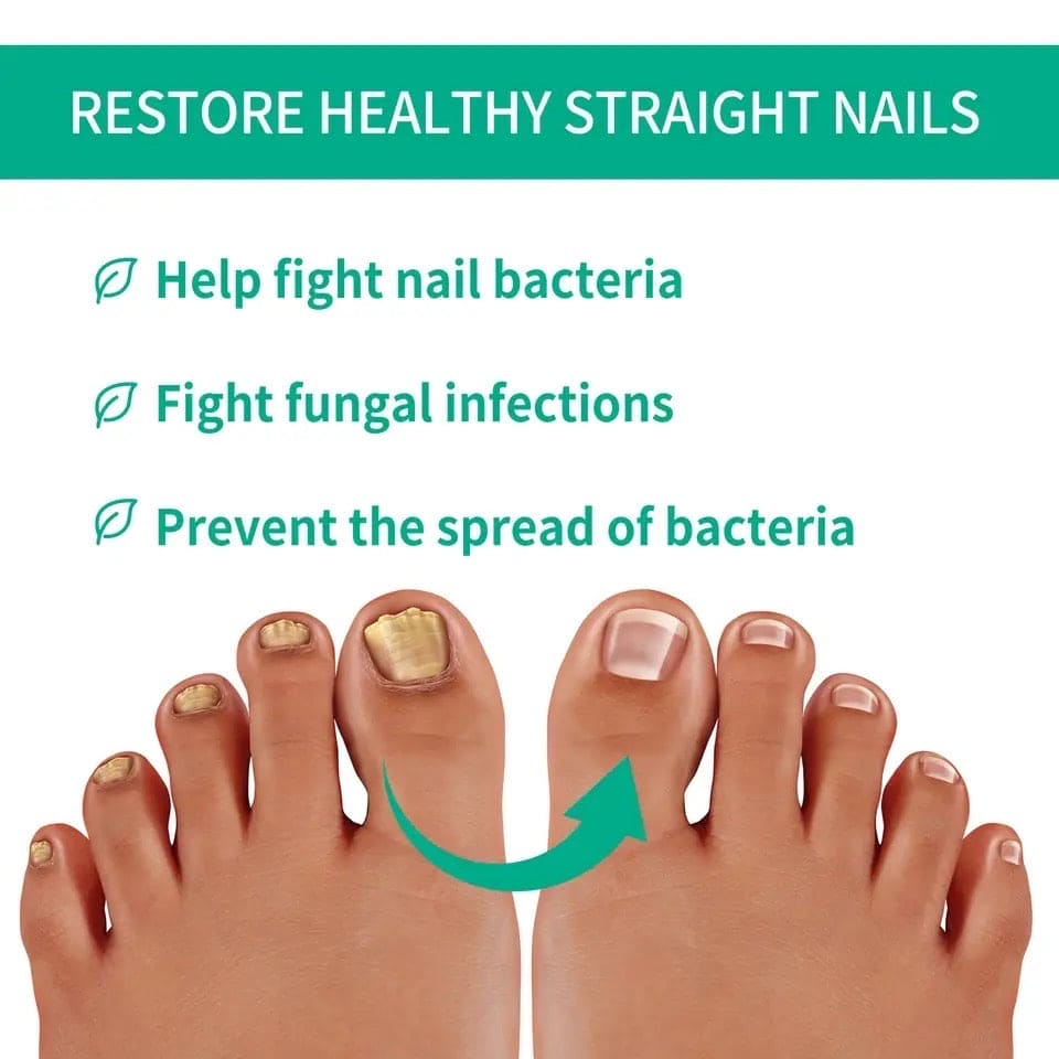 Nail Fungus Solution, Anti Infection Nail Fungus Removal Gel, Ingrown Toenail Treatment Nail Care Oil, Nail Fungus Treatments Serum